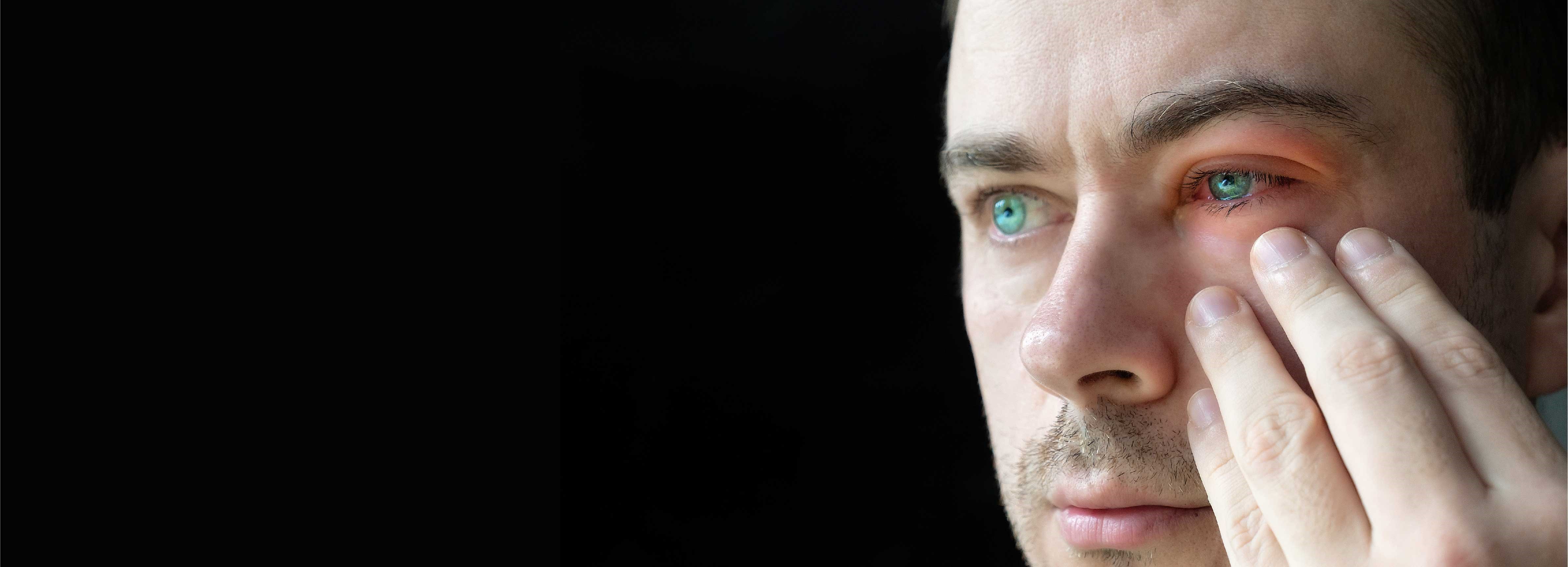 Conjunctivitis What is Conjunctivitis?